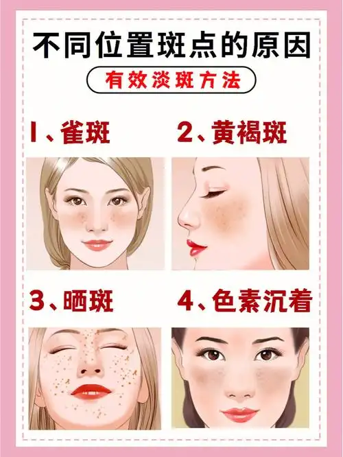 变美必看不同位置长斑的原因