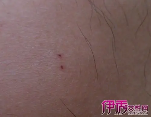 【图】老鼠咬伤伤口特点是 3种情况发生需尽快就医