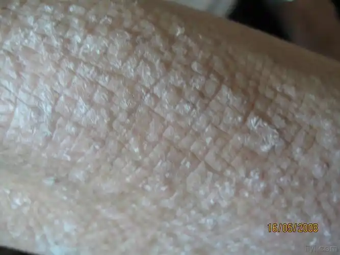 皮肤淀粉样变的治疗