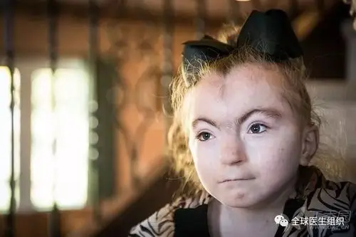 鉴别不同遗传亚型的noonan综合征患者