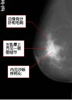 69 康复医学讨论版 69 乳腺钼靶照片的应用   二,乳腺癌(见下图)