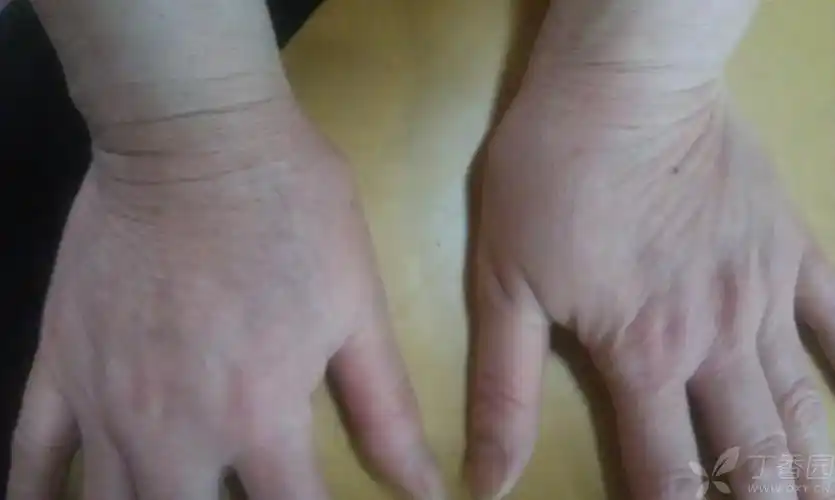 第一掌腕关节畸形