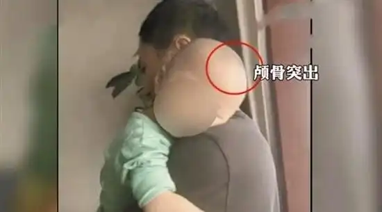 出现湿疹,体重严重下降,头骨畸形酷似"大头娃娃"及不停拍头等异常情况