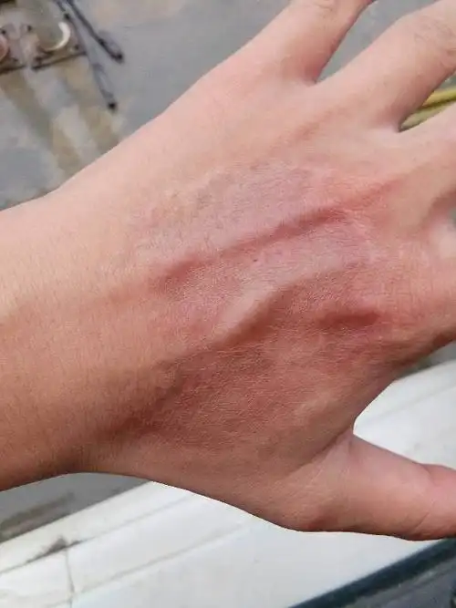 深二度烫伤,现在已经5个月了,有色素沉着,我该怎么办~?