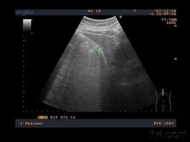 萎缩性胆囊炎胆结石 - 超声医学讨论版 - 爱爱医医学论坛