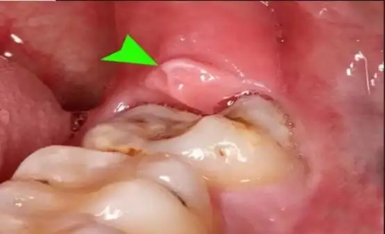 牙龈肿痛有口难开盲目降火不可取