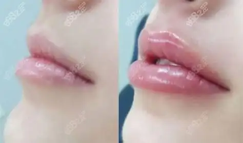 伊婉玻尿酸丰唇对比