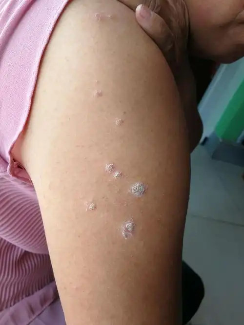 牛皮癣实例 - 美篇