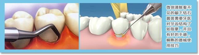 龈下根面刮治清除牙龈下牙根表面的结石,菌斑,消除牙周炎症,促进牙周