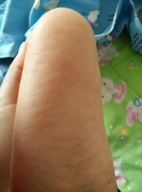 宝宝脚底有红点,是血热吗