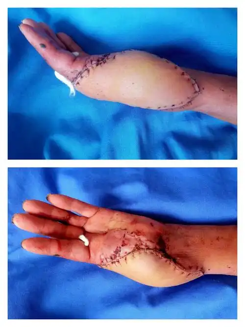 术后第8天,移植皮瓣成活良好.