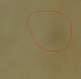 同问肚皮上有小肉球请问是什么东西,可能是什么原因因起的?见图