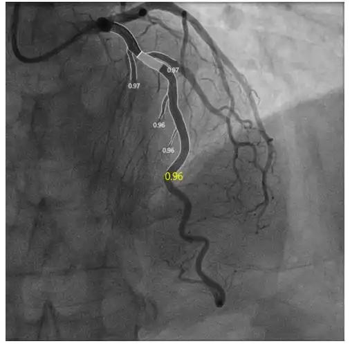 海神之戟,克难攻坚——"斜面旋切"棘突球囊导管减少斑块位移,助力开口