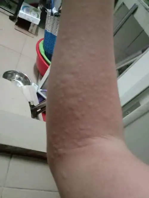 如何预防海鲜过敏