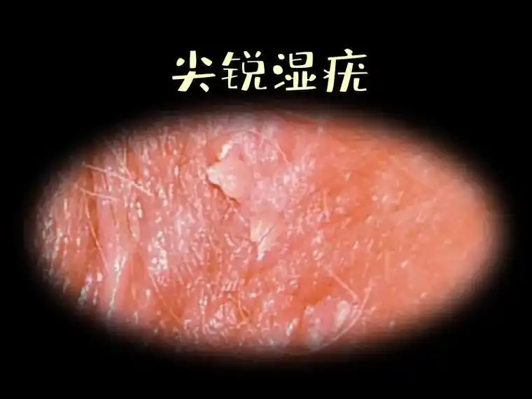 尖锐湿疣