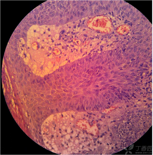 【求助】良性肿瘤?来源?