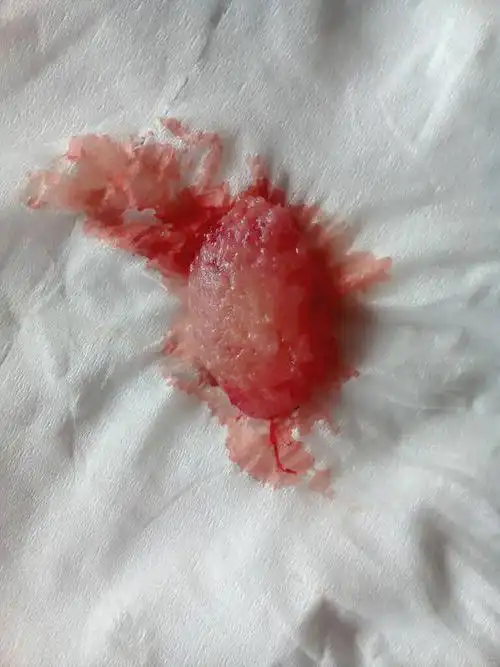 药物流产排出物图片