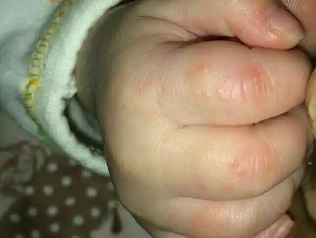 20天的宝宝手上长了小水泡,要紧吗?