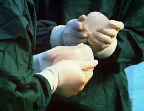 直击沈阳变性人手术全过程