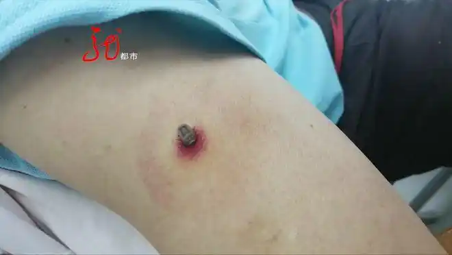 蜱虫竟然在耳边安家还在里面产卵刚钻入皮肤时一般不觉得疼