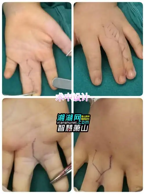 萧山一孩童出生有六指并指,术后恢复正常