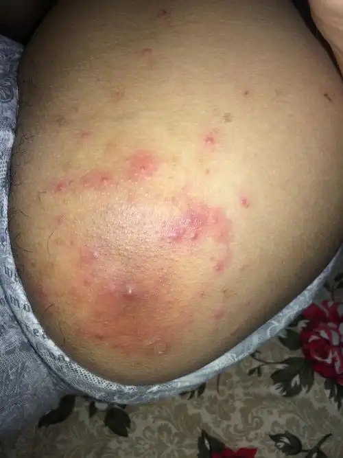 如图,屁股上长的东西,不疼不痒,抠就会有一点疼,有人说股癣,但是股癣