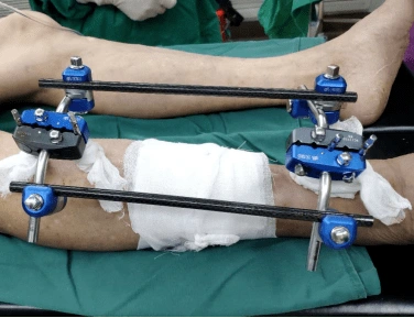 外固定支架创伤小更有利于术后恢复,对于开放性骨折或感染无法第一