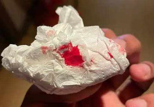 血的卫生纸,看起来确实有些吓人,而且斯里坎斯的鼻子流血是非常明显的