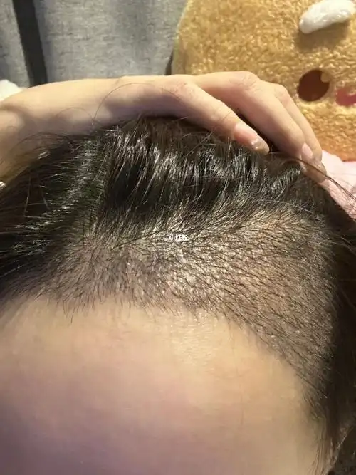 植发16天本来以为毛囊炎不可能找上我