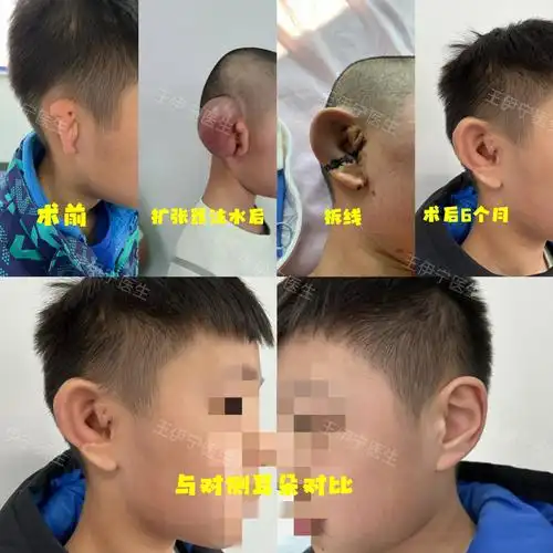 小耳畸形治疗方式:扩张器法耳再造