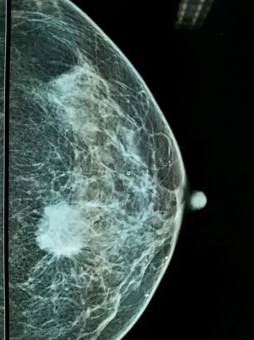 又一例典型的乳腺癌