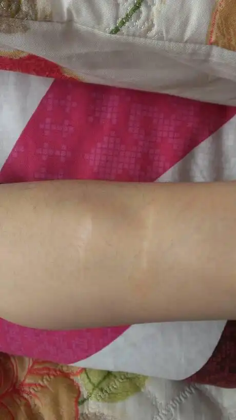 请问我的手臂上的这种疤痕能修复好吗?