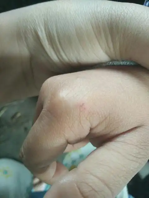 急急急,小孩三岁被狗咬破皮了.到没出血