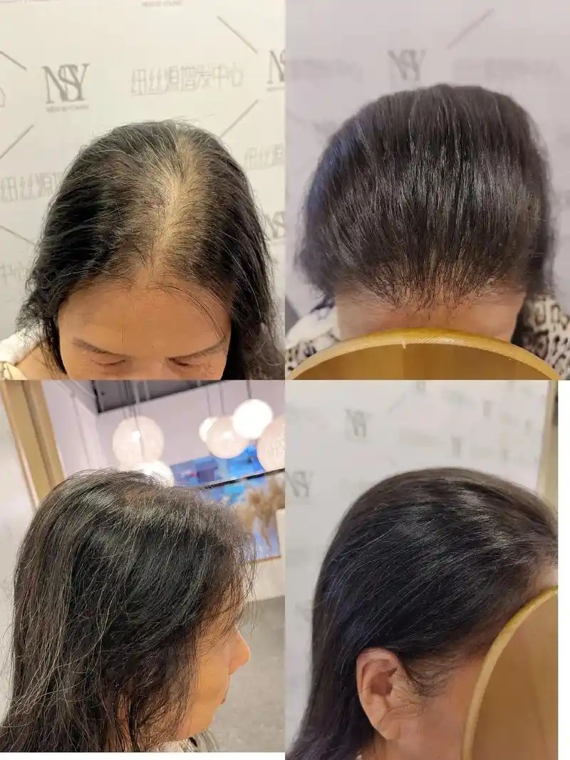 超级女性头顶稀疏案例集合,这效果,莫摆了#增加发量 #头发稀 - 抖音