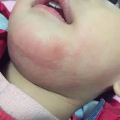 最近这几天宝宝的下巴一直这样泡疹,不知道是怎麼,跟以前流口水扎起了