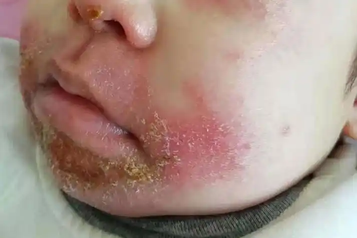 婴儿湿疹图片和症状