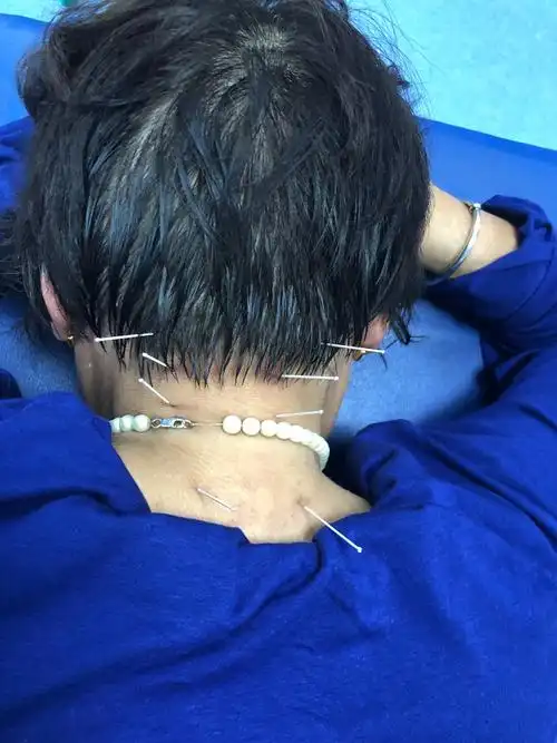 针灸治疗颈肩腰腿疼