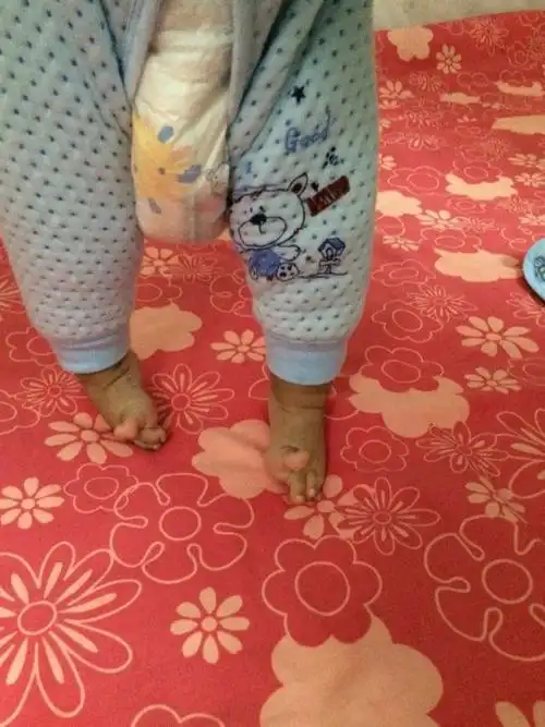 两脚外翻.站立时脚不能平放.请问是什么问题怎么治疗