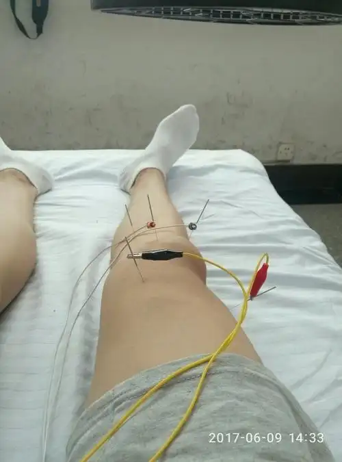 膝盖积液是一种怎样的体验