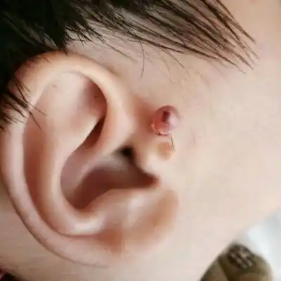 女儿出生耳朵上长两个小肉丁,有人说用头发可以绑掉,我就用头发帮住