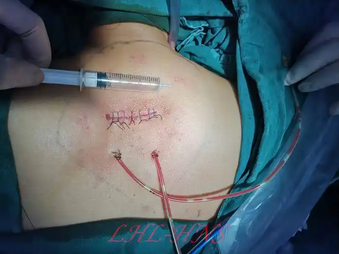 miccoli手术拓展:一例颈后巨大脂肪瘤切除的感悟