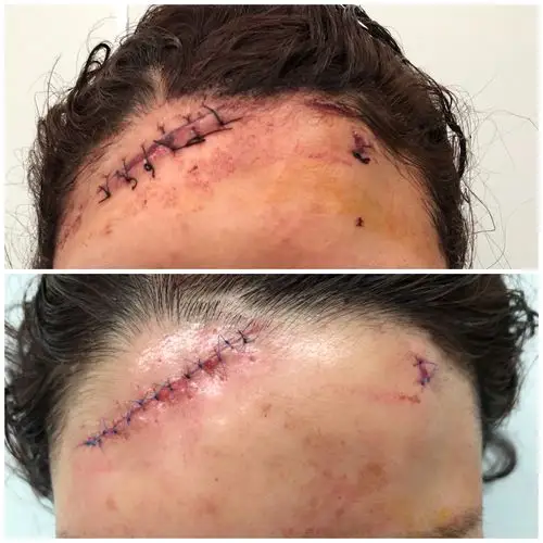 什么是美容缝合? - 好大夫在线