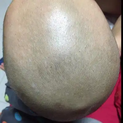 哪位宝妈遇到过这种情况,我儿子头上的白斑点是什麼东西,有同样情况的