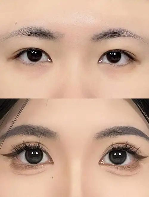 小内双如何打造欧式双眼皮