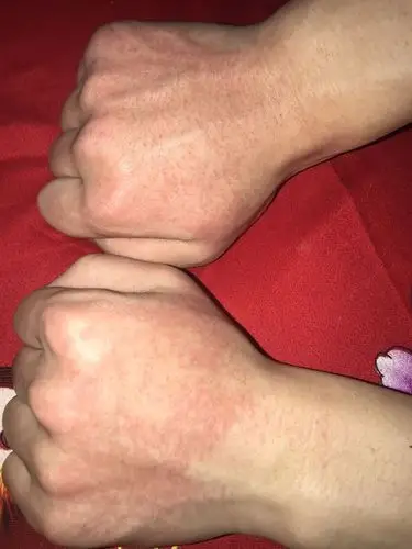 手上起了好多红点 不是烧伤也不是冻伤 这是咋回事