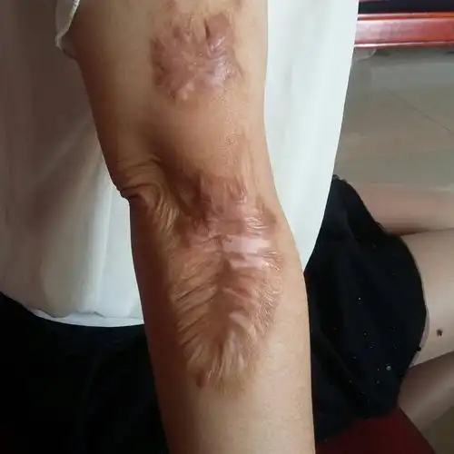 不敢穿短袖,求求各位大神,有什么好的去疤痕的药可以帮我解这一烦恼呢