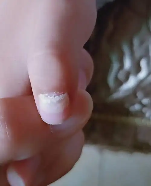 三岁半,就这两天开始发现手脚指甲从月牙开指像钙化一样,请问是灰指甲