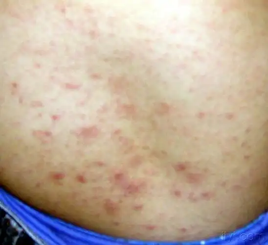 特效多能的疥疮方 - 中药学讨论版 - 爱爱医医学论坛 - 爱爱医医学网