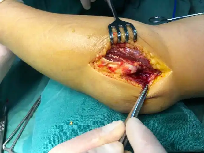 一例肘关节内翻后内侧旋转损伤的分享