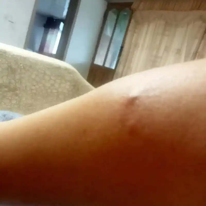 给大家分享一下我得恙虫病的全过程!希望大家注意一下! - 抖音